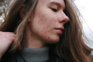 Acne: Understanding Symptoms, Problems, and Saliva Hormone Testing as a Potential Solution